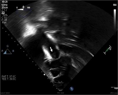 Case report: Bordetella holmesii: A rare pathogen causing infective endocarditis associated glomerulonephritis